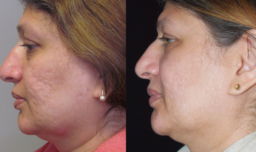 rf laser skin rejuvenation scars before after mississauga oakville